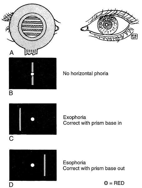 馬竇氏鏡|Motor Signs in Heterophoria and Heterotropia